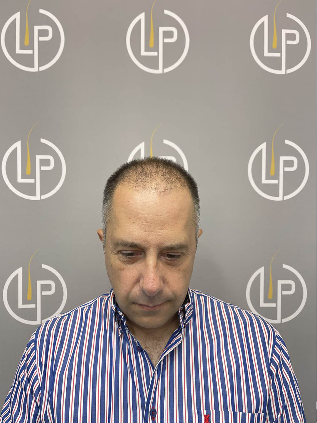 Περιστατικό ασθενούς — πριν την αποκατάσταση μαλλιών